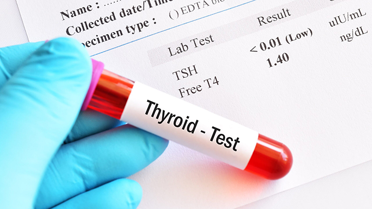 Thyroid Gland Lab - Blood T4 Thyroid Test
